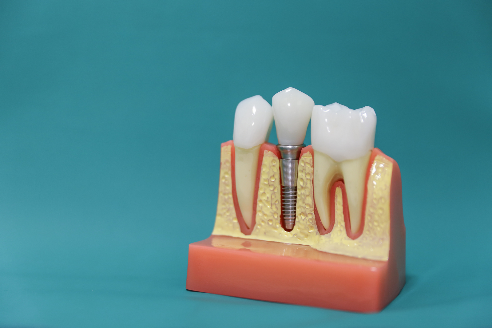How Can You Benefit from Implant Dentistry?