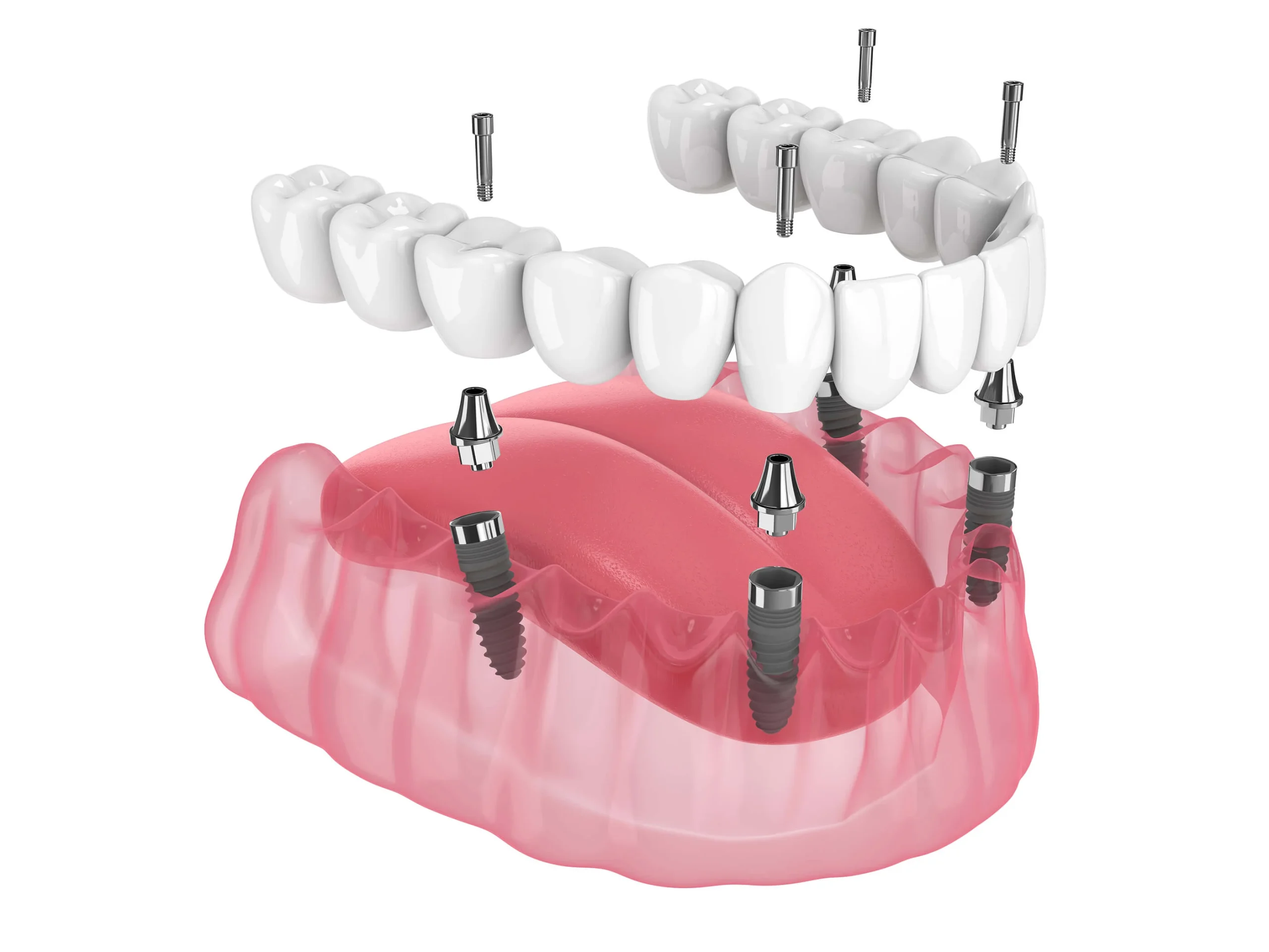 dental implants Temecula, CA